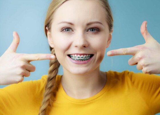How Long Do Braces Take to Straighten Teeth? Read Here